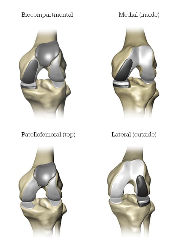 Knee Compartments for partial knee replacement Knee Compartments for partial knee replacement