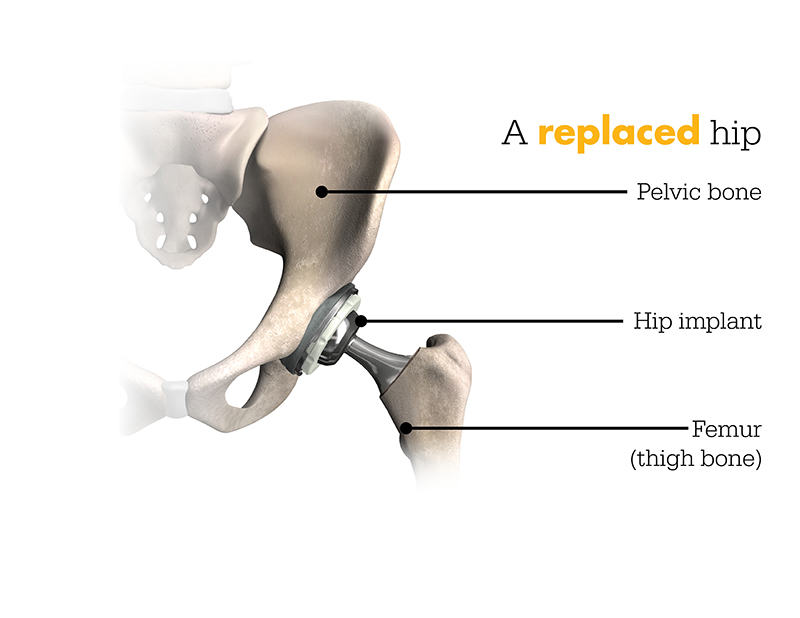 A replaced hip A replaced hip