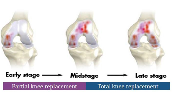 Partial Knee Replacement vs Total Knee Replacement Partial Knee Replacement vs Total Knee Replacement